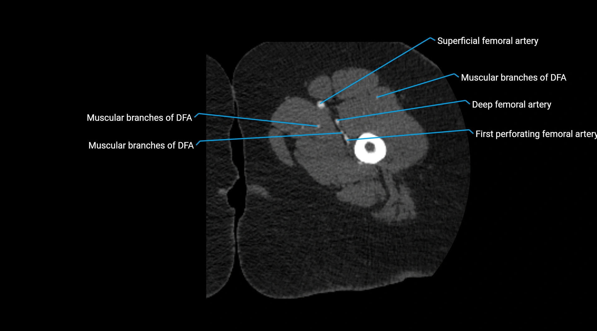 CTA lower limb cross sectional anatomy labelled image _96.webp